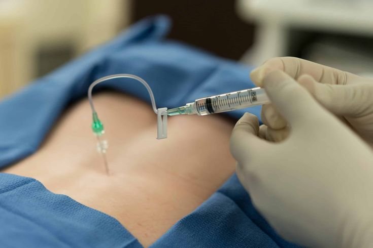 Epidural Steroid Injection
