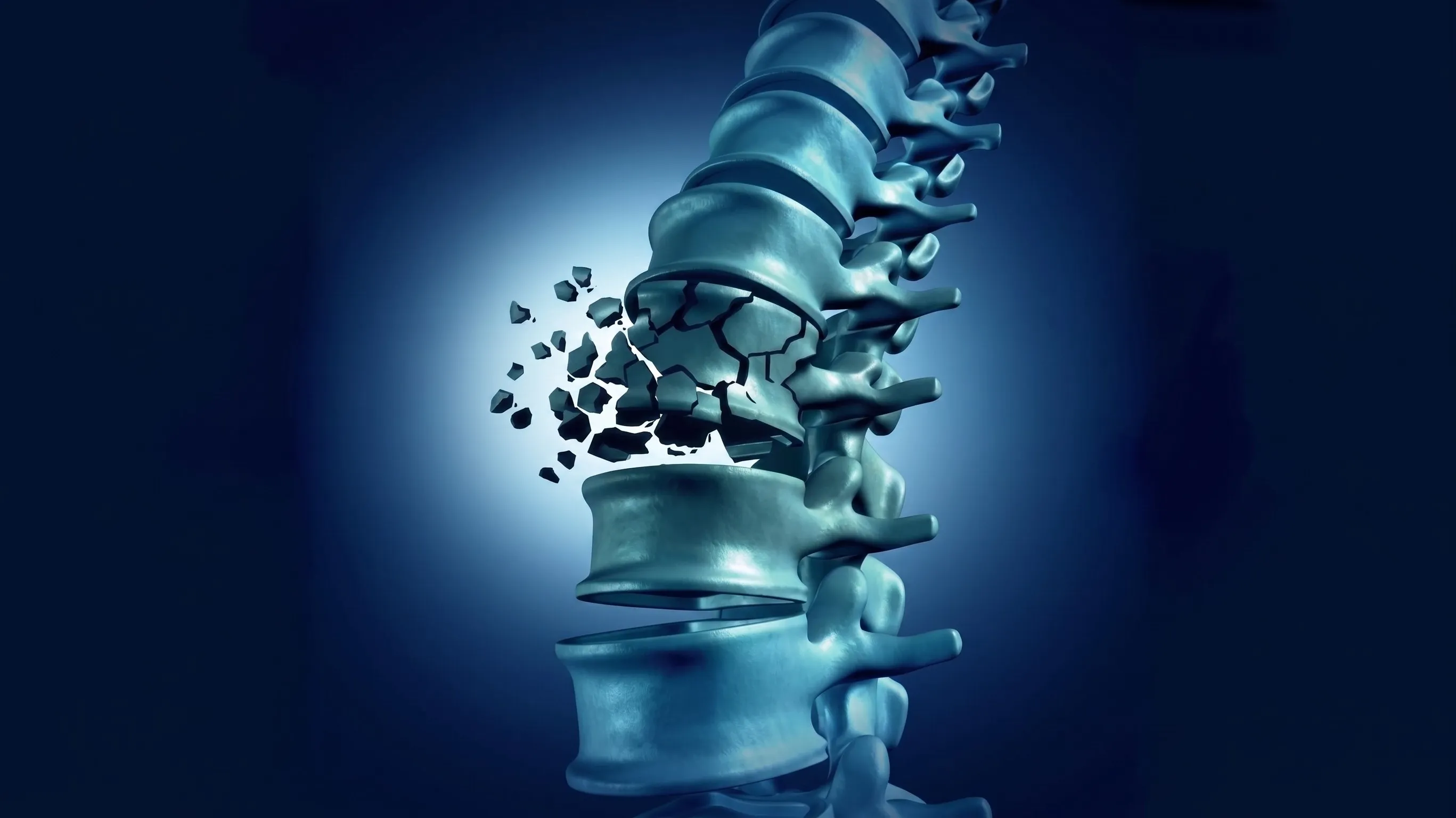 Osteoporotic Vertebral Compression Fracture Spine Anatomy