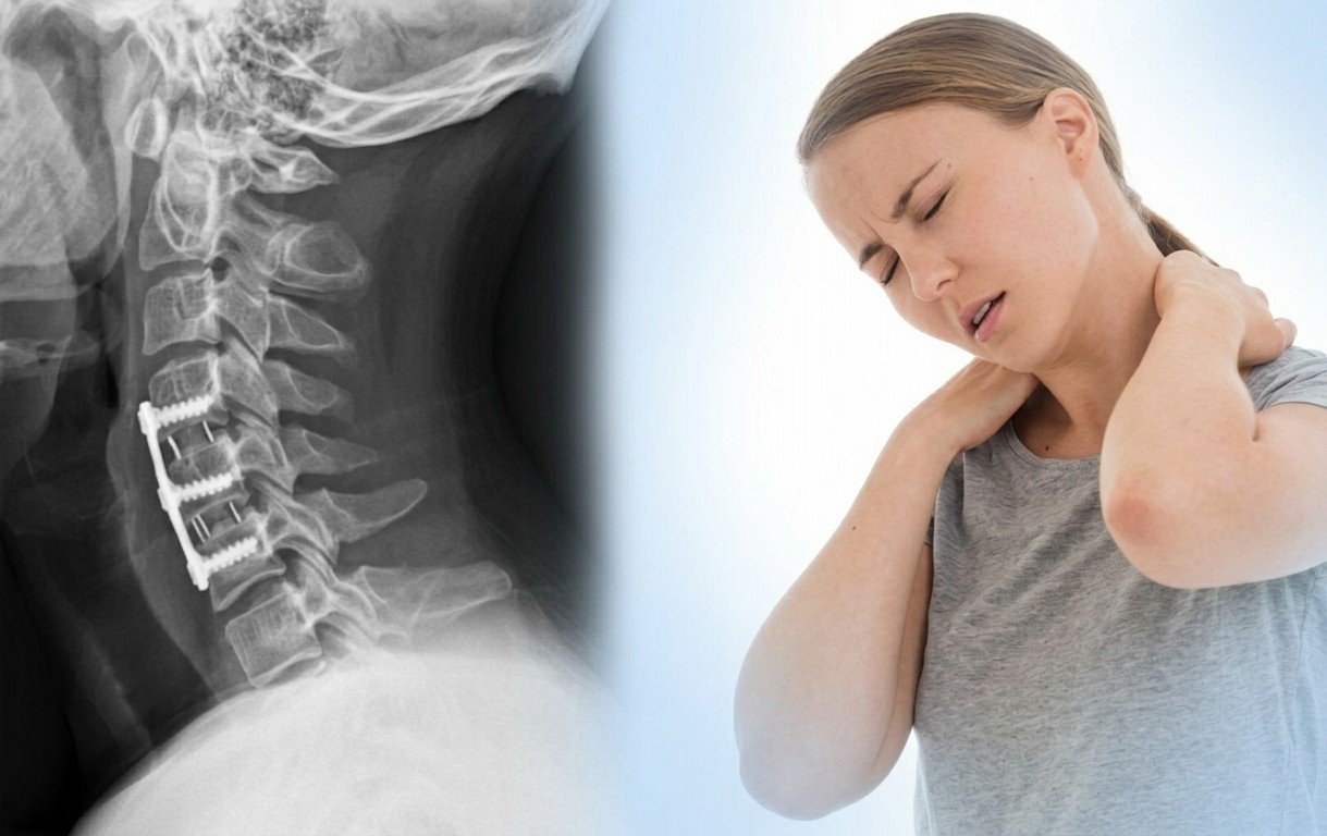 Cervical Neuroplasty