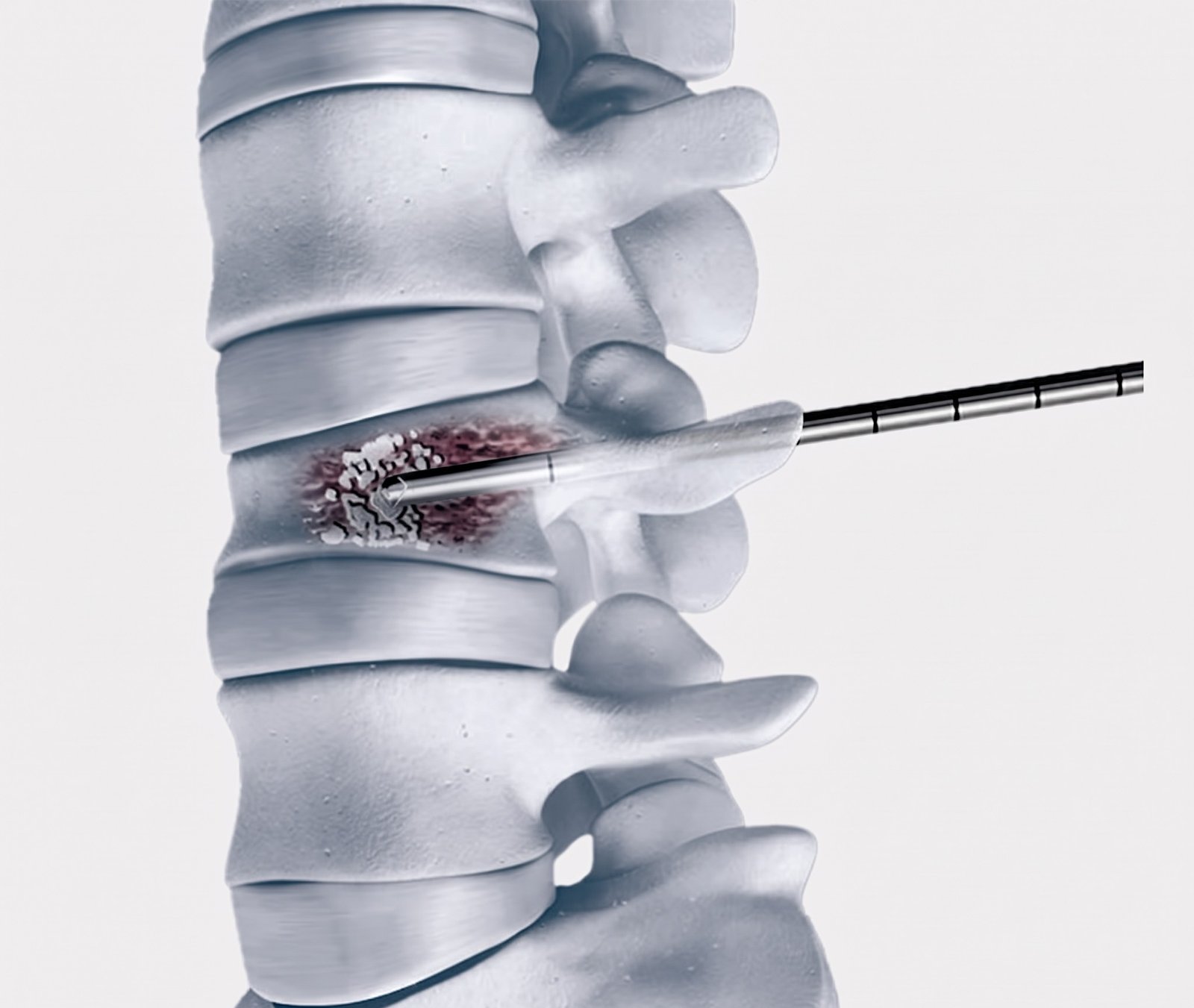 Vertebroplasty